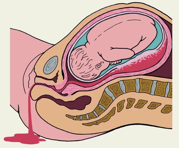 Выходит матка после родов. Ретроплацентарная отслойка плаценты. Преждевременная отслойка плаценты. Ретроплацентарная гематома. Преждевременная отслойка плаценты Акушерство.