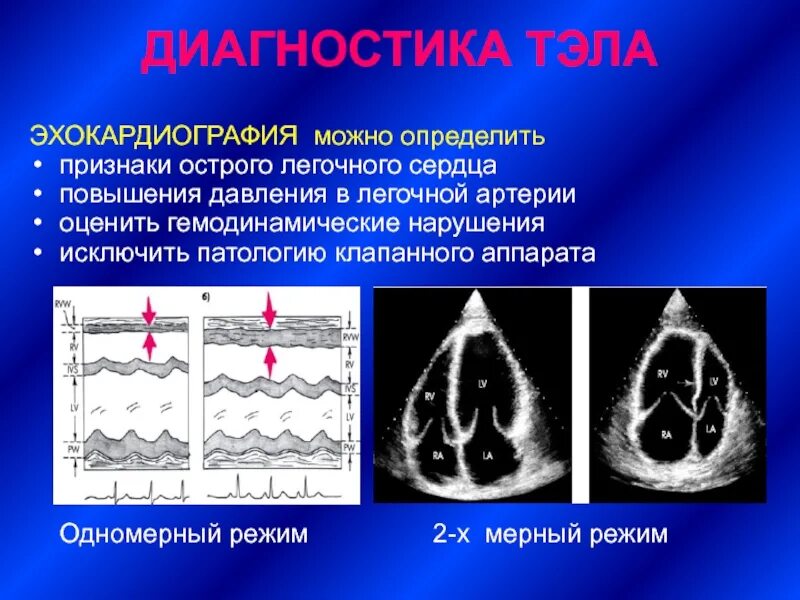 Эхо экг где сделать. Легочная гипертензия эхокардиография. хроническое легочное сердце на эхокг. признаки тэла на эхокг. эхокг при гипертрофии правого желудочка.