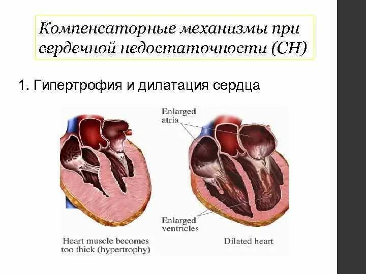 Компенсаторные механизмы сердечной недостаточности. Компенсаторные механизмы при сердечной. Компенсаторные механизмы при сердечной недостаточности. Гипертрофия и дилатация сердца отличие. Дилатация полостей предсердий