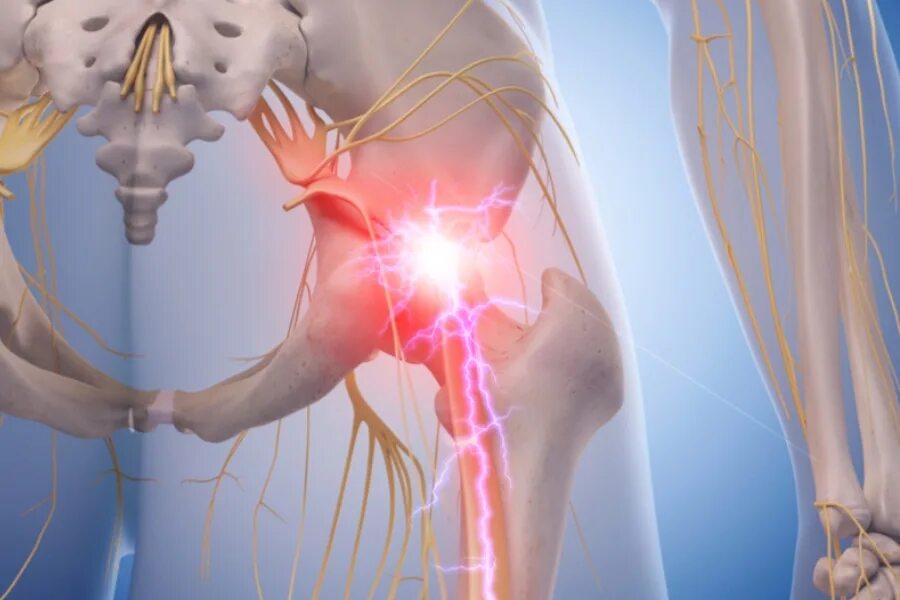 Корешковое защемление в пояснице. Тазобедренный сустав седалищный нерв. Защемило седалищный нерв. Защемление седалищного нерва.