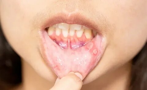Muh Ke Chale Home Remedies Is Aloe Vera Jel, Bakong Soda And Honey Best Mouth Ul