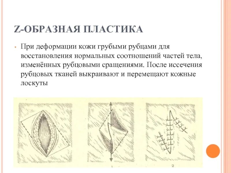 Женские малые половые губы. Z образная пластинка по Лимбергу. Z образная пластика треугольными лоскутами. Зет образная пластика по Лимбергу. Z-образная кожная пластика по Лимбергу.