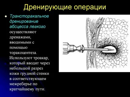 Удаление дренажа