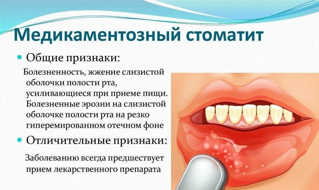 Афтозный и язвенный стоматит. Стоматит воспаление десен. Герпетиформный стоматит. Стрептококковый стоматит. Воспаления слизистой кроссворд