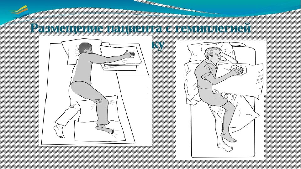 Перемещение и размещение пациента. Размещение пациента с гемиплегией в положение фаулера. размещение пациента на спине с гемиплегией. размещение пациента с гемиплегией на животе. размещение пациента с гемиплегией в положение на спине.