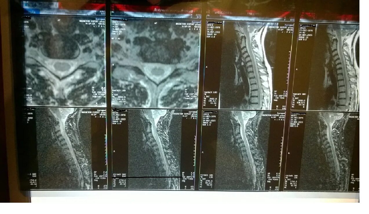 Мрт шейного отдела позвоночника по времени. Мрт шейного отдела. Остеохондроз на кт. Кт шоп. Кт позвоночника при остеохондрозе.