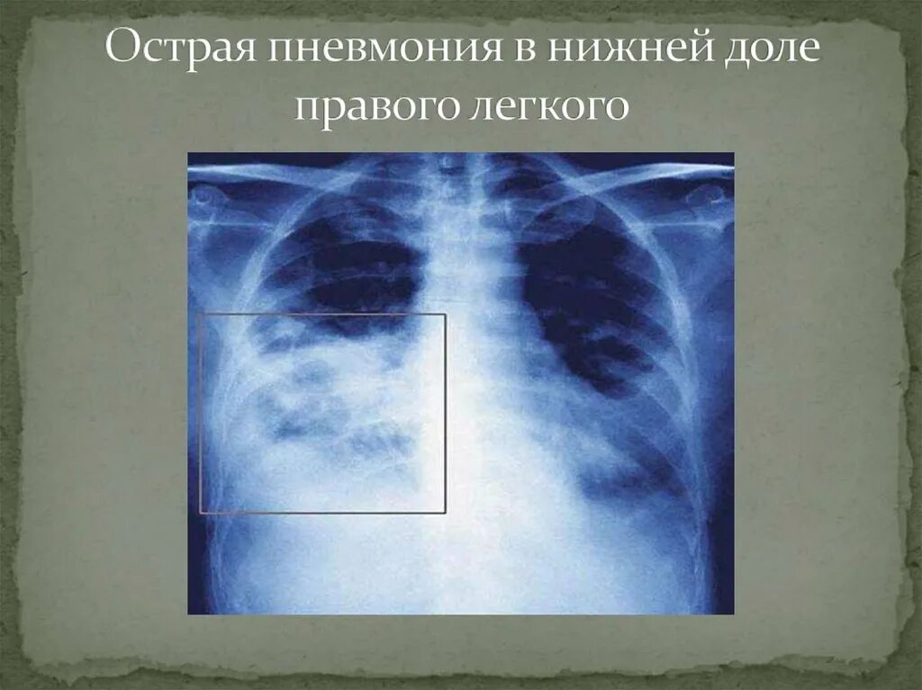 Пневмония в правой нижней доле. Внебольничная правосторонняя пневмония. Правосторонняя очаговая пневмония рентген. Пневмония нижней доли рентген. Очаговая пневмония правого легкого.