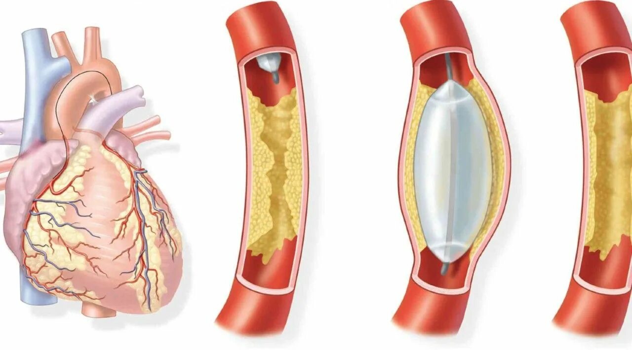 Баллонная ангиопластика коронарных артерий. ТРАНСЛЮМИНАЛЬНАЯ коронарная ангиопластика. Баллонная ангиопластика и стентирование. Коронарное стентирование сосудов сердца. Расширяет коронарные сосуды