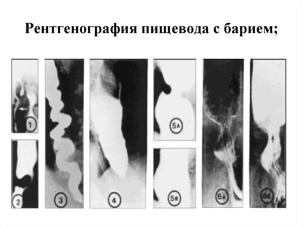 Пищевода с барием