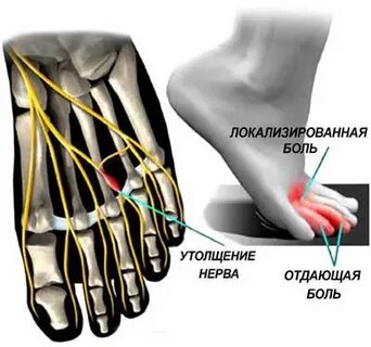 Неврома мортона ног