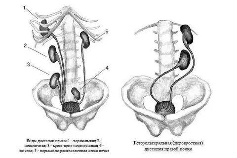 Тазовая дистопия