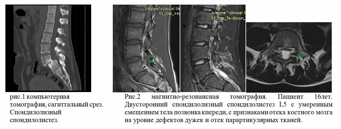 Трабекулярный отёк позвонков мрт. Отек костного мозга позвонка на мрт. Трабекулярный отек костного мозга позвоночника. Участки отека костного мозга