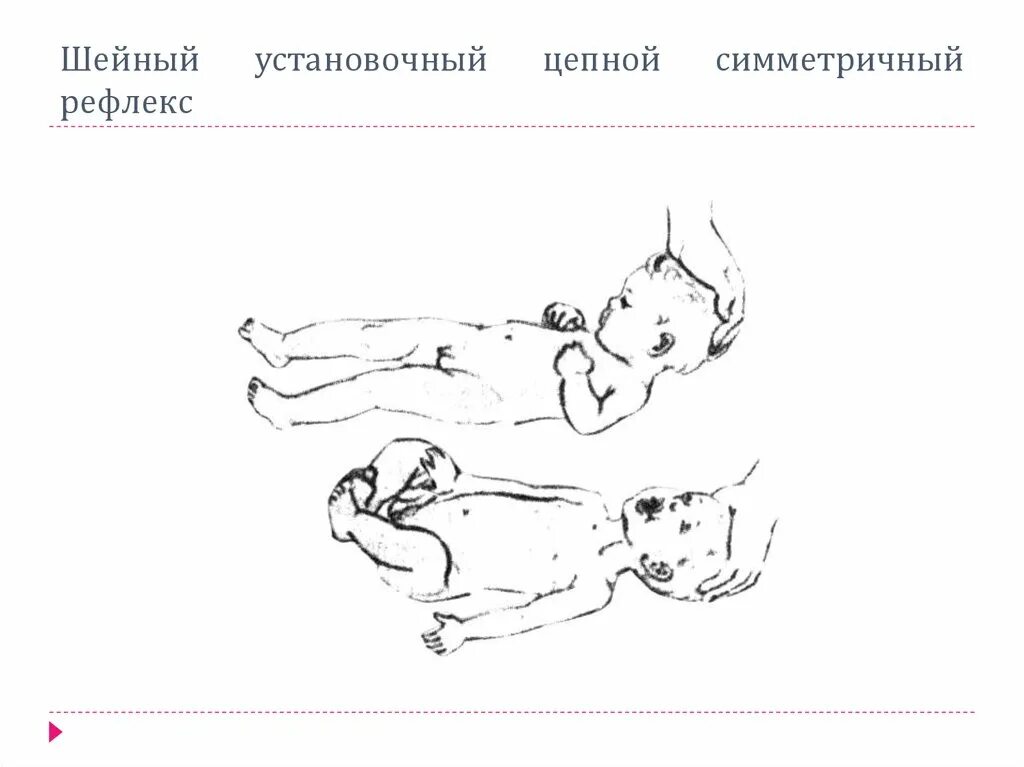 Шейный рефлекс. Шейно тонический рефлекс. тонические рефлексы при дцп. шейные и лабиринтные тонические рефлексы. лабиринтный тонический рефлекс.