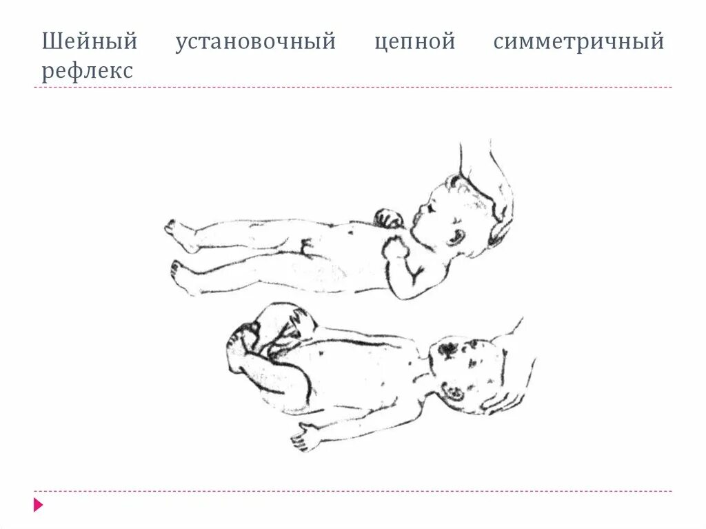 Шейно тонический рефлекс. Тонические рефлексы при ДЦП. Шейные и лабиринтные тонические рефлексы. Шейно тонический рефлекс новорожденных.