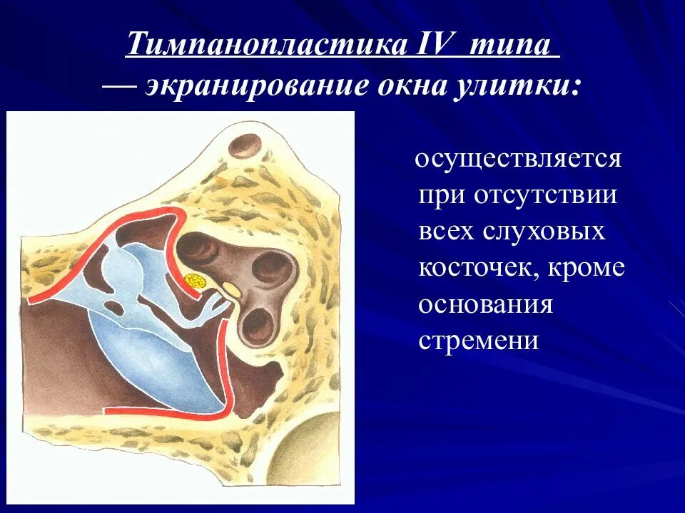 Тимпанопластика Вульштейну. Тимпанопластика миринготомия. Отосклероз уха операция