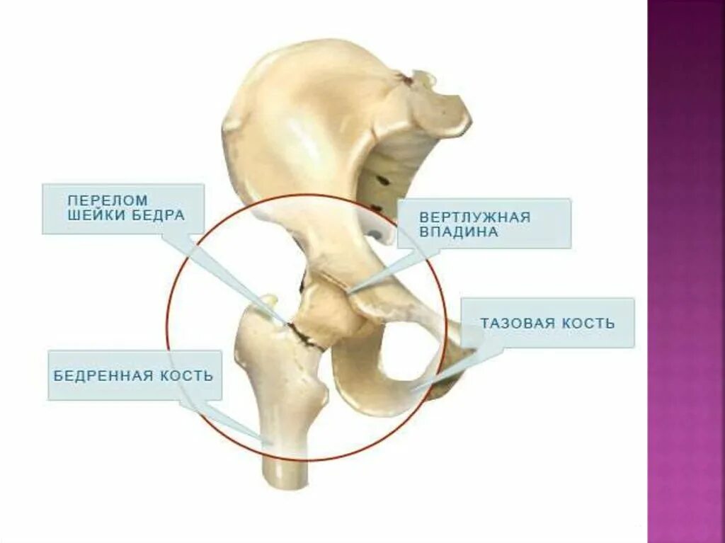 Кость где бедро. Анатомия вертлужной впадины тазобедренного сустава. Тазобедренный сустав перелом шейки бедра. Таз вертлужная впадина перелом. Перелом тазобедренного сустава шейка бедра.