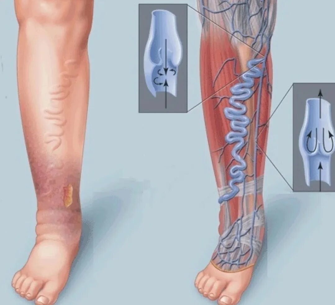 Сосуды нижних конечностей врач. Хроническая венозная недостаточность (ХВН). Варикозное расширение вен нижних конечностей ХВН. Варикозное расширение вен нижних конечностей ХВН с2 3s.