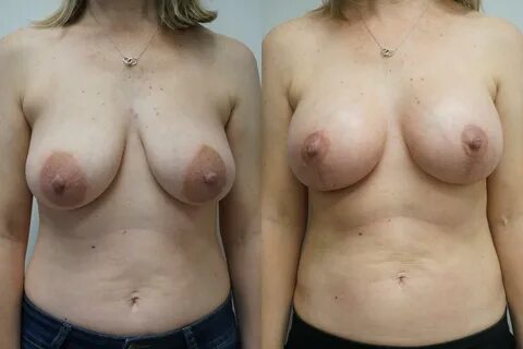 Before & After Breast Lift with Implants Case 285 Front View in Gilbert...
