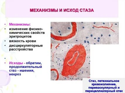 Стаз это
