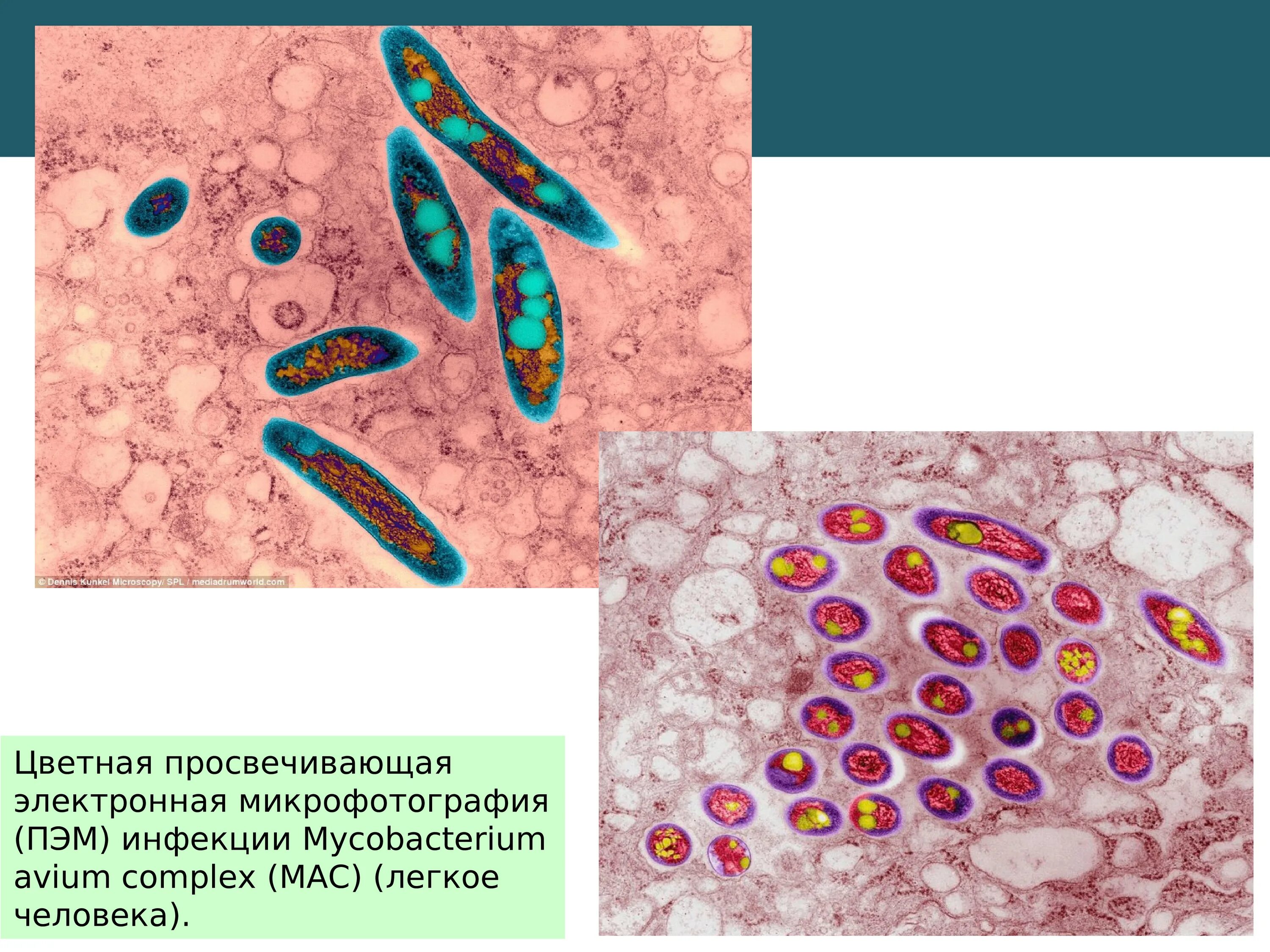 Диссеминированный микобактериоз. Микобактериоз клиника. Нетуберкулезный микобактериоз