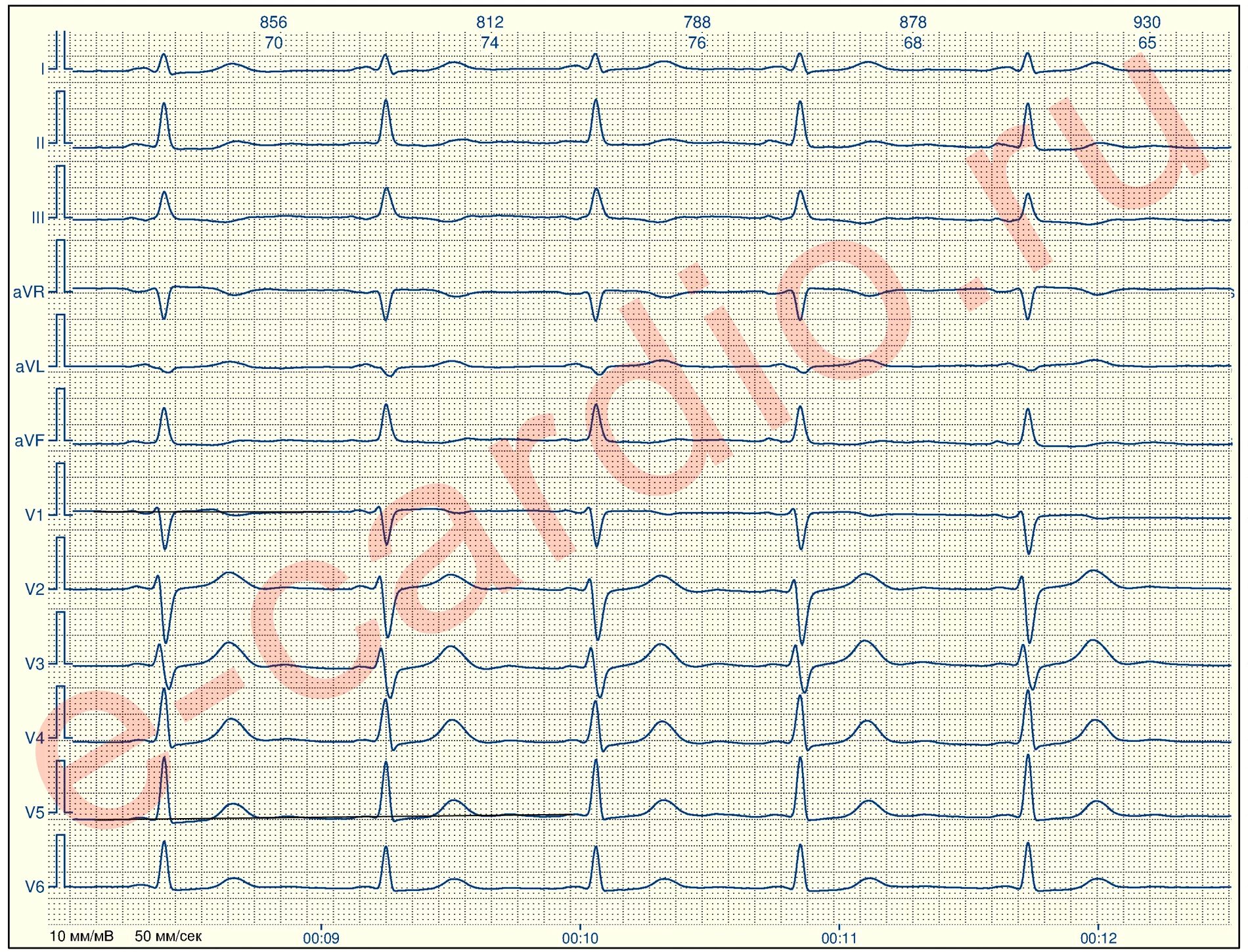 Индекс Соколова-Лайона на ЭКГ. Гипертрофия левого желудочка на ЭКГ индекс Соколова. Корнельское произведение ЭКГ. Корнельский вольтажный индекс на ЭКГ. Перегрузка на экг что это