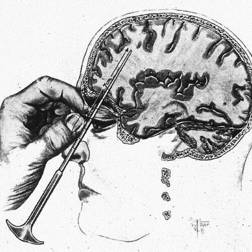 Орбитальная Лоботомия. Трансорбитальная Лоботомия. Лоботомия сейчас делают
