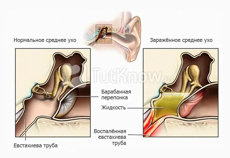 Заложенность уха тубоотит. Евстахиева труба анатомия. Воспаление слуховой трубы. Слуховая евстахиева труба. Заболевания среднего уха.