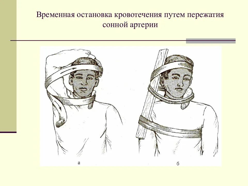 Остановить кровотечение на сонной артерии ответ тест. Остановка артериального кровотечения сонной артерии. Способы временной остановки кровотечения из сонной артерии. Наложение жгута при кровотечении из сонной артерии. Наложить жгут при кровотечении из сонной артерии.