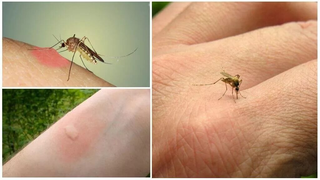 Сколько укусов комаров. Малярийный комар кусается.