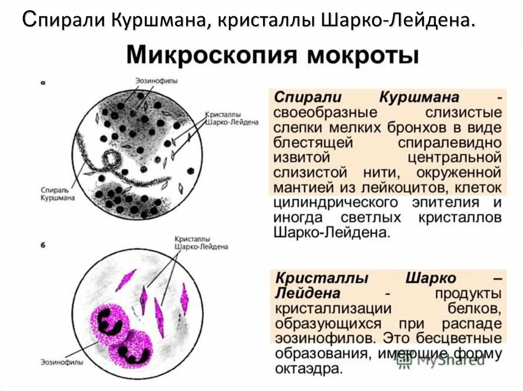 Микроскопия мокроты спирали Куршмана. Спирали Куршмана, Кристаллы Шарко-Лейдена, эозинофилы. Клетки при микроскопии мокроты. Спирали Куршмана в мокроте. Слизи характеристика