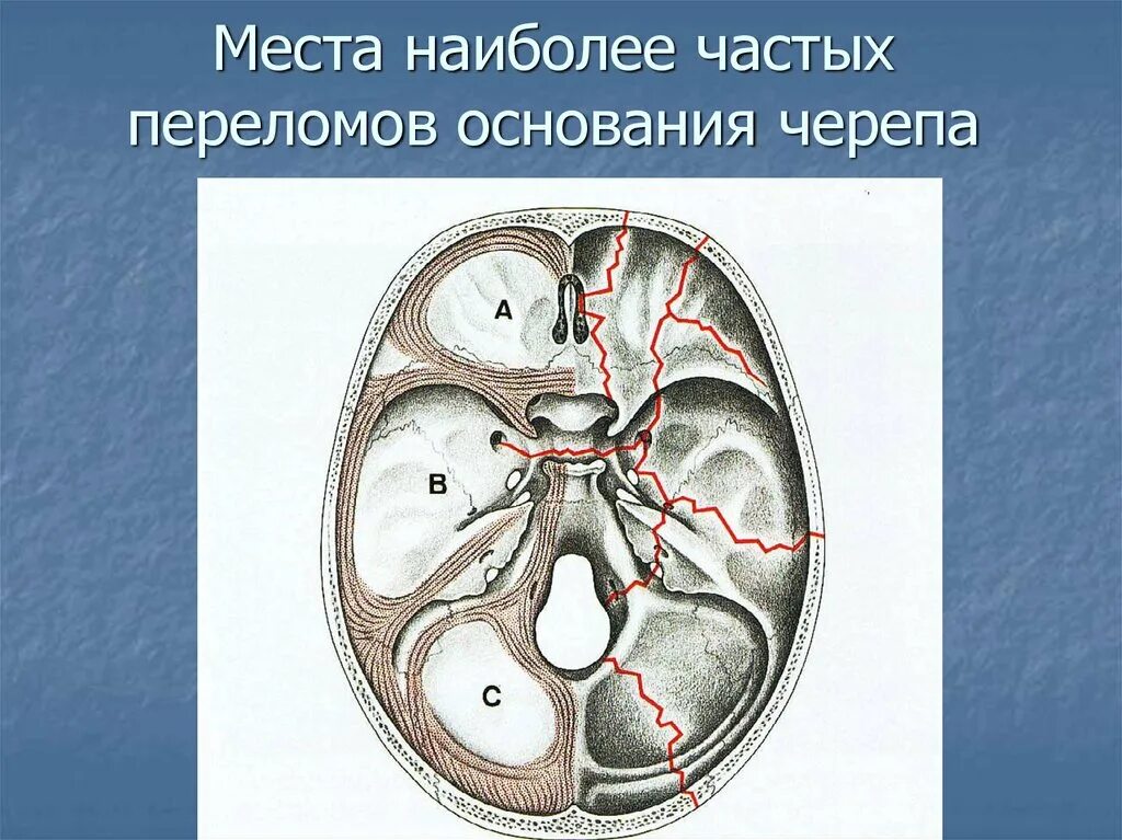 Для перелома основания черепа характерно. Перелом средней черепной ямки. Перелом основания черепа перелом черепной ямки. Кольцевидный перелом основания черепа. Симптомы перелома средней черепной ямки.