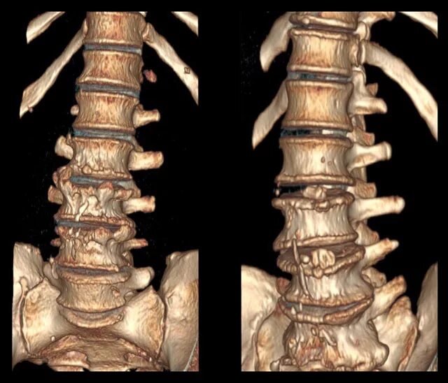 Деформирующий спондилез th9-th10. Что такое спондилез позвоночника поясничного. Спондилёз поясничного крестцового отдела. Спондилез с3-с7 позвонков. Картина спондилеза