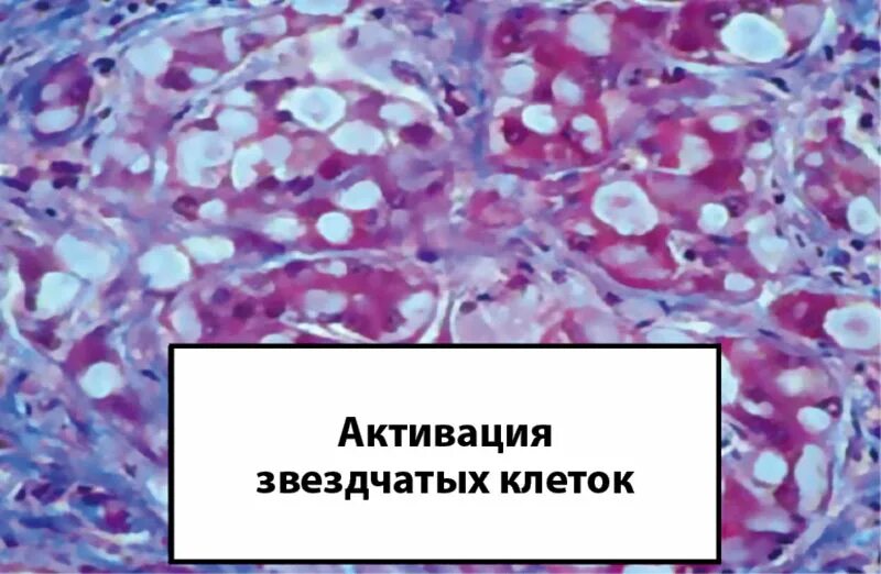 Диффузный стеатоз что это. Фокальный стеатоз печени. биопсия печени при циррозе. микровезикулярный стеатоз печени. очаговый стеатоз печени.