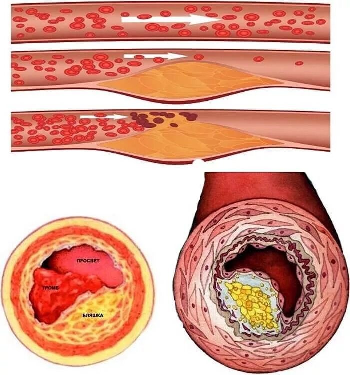 Атеросклероз бляшки сосудов. Атеросклероз холестериновая бляшка. Атеросклероз дистрофия. Атеросклероз венечных артерий.