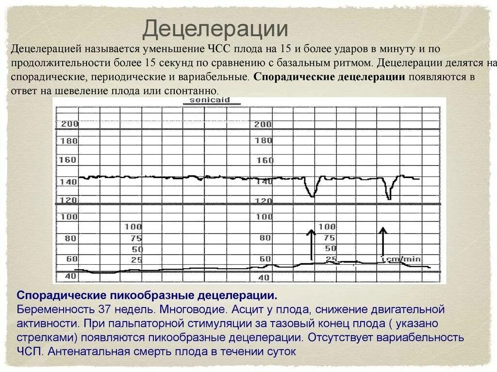 Исследование сердцебиения плода. Поздние децелерации на КТГ. Акселерация и децелерация на КТГ. КТГ плода децелерации. КТГ плода расшифровка акцелерации и децелерации.