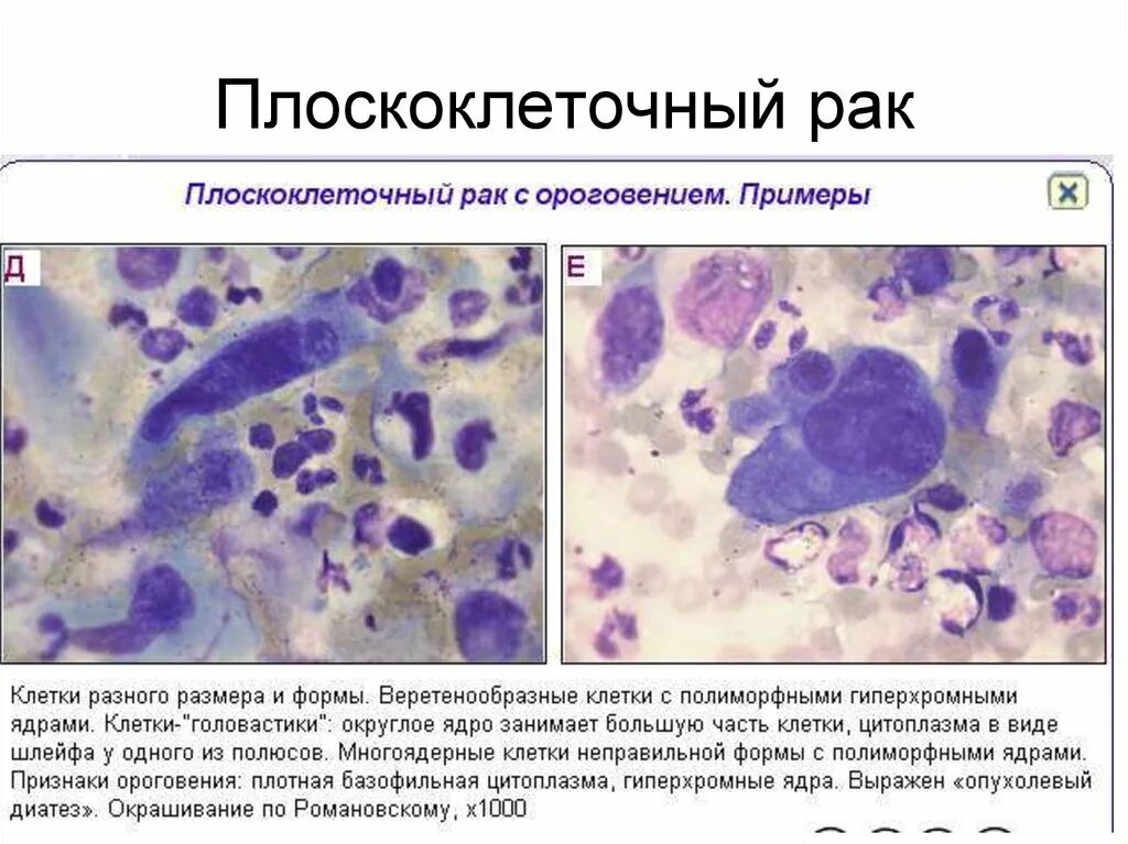 Плоскоклеточное поражение низкой степени. Пролиферация гиперплазия цитология. Базалиома цитологическое исследование. Плоскоклеточный неороговевающий. Плоскоклеточная карцинома шейки матки гистология.