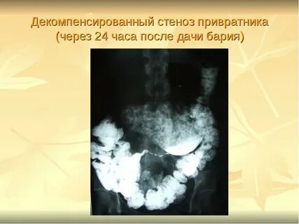 Рубцовая деформация привратника