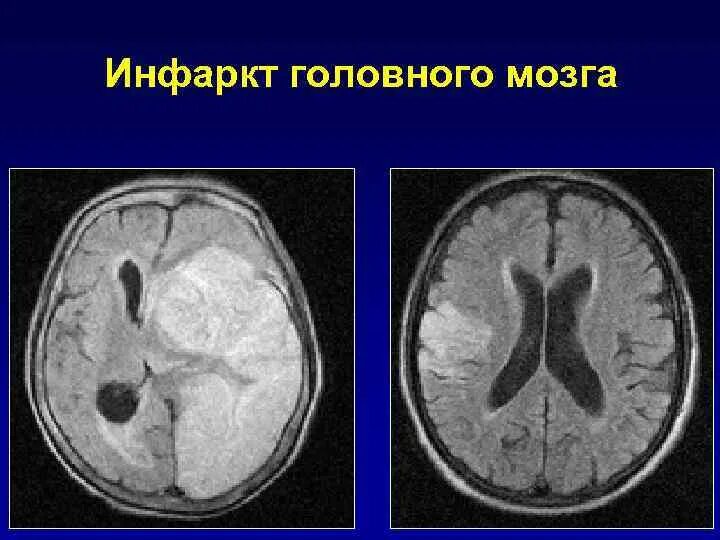 Инфаркт мозга неуточненный. Инфаркт головного могза. Инфаркт головного мозга и инсульт. Инфаркт головного мозга Патан.