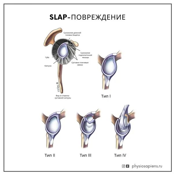 Slap 1 повреждение суставной губы.