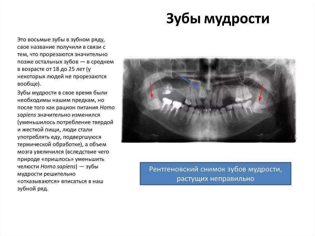 Зуб мудрости это какой по счету зуб. Зубы мудрости какие посчеьу. Зуб мудрости растет снизу. Сколько зубов мудрости может быть у человека