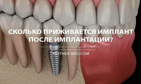 Сколько времени делать имплант