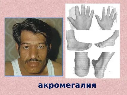 Акромегалия