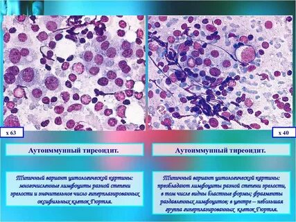 Цитология щитовидной