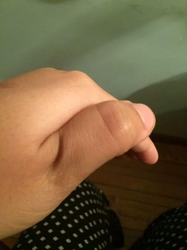 Вывих большого пальца на руке. Вывихнут палец на руке что делать. Вывихнут палец на руке что делать. Фиксатор сухожилия разгибателя пальца. Вправление вывиха мизинца кисти.