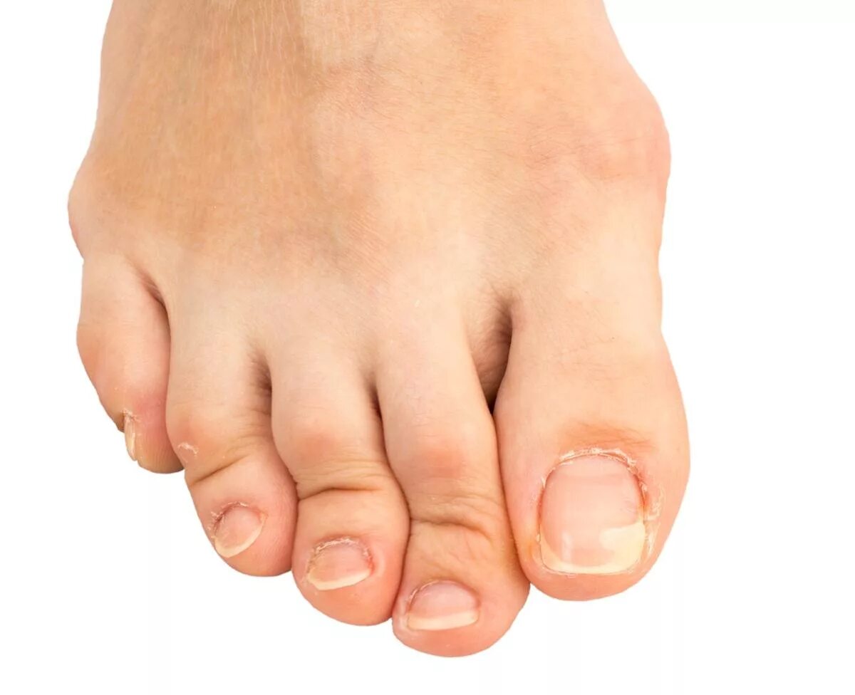 Короткий стоп. Молоткообразная деформация пальца стопы. Когтеобразная деформация пальцев стопы. Молоткообразные пальцы ног. Деформация мизинца на ноге.