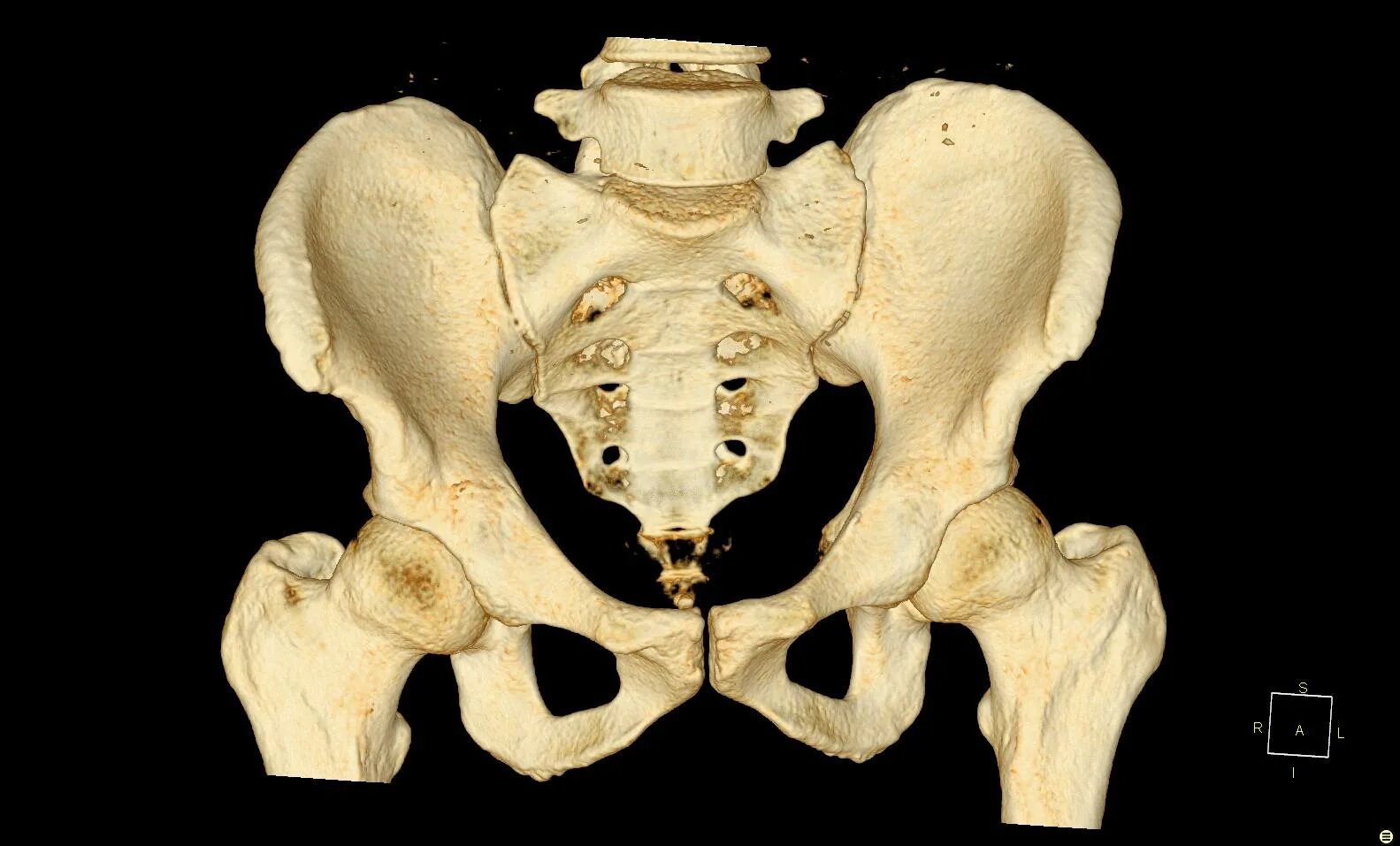 Тазовые кости скелета человека. Тазовая кость кости. Лонная кость анатомия кт. Седалищная кость скелет. Кости таза анатомия.