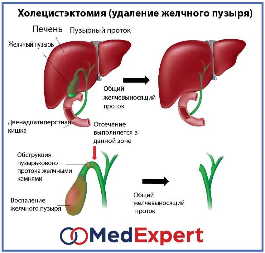 Холецистит холелитиаз. Перегиб желчевыводящих протоков. При заболевании желчного пузыря.