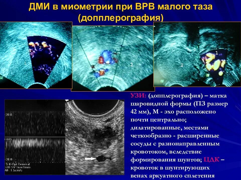 Варикоз органов таза у женщин. Расширение вен малого таза по УЗИ. Допплеровское исследование сосудов малого таза. Варикоз вен малого таза УЗИ. Варикоз вен малого таза эхограмма.