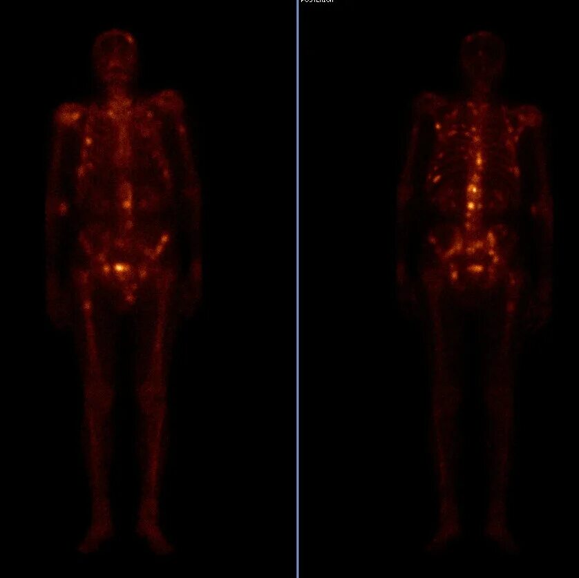 Сцинтиграфия (радионуклидная диагностика). Сцинтиграфия метастазы в кости. Сцинтиграфия скелета норма. Метастазы в кости на сцинтиграфии.