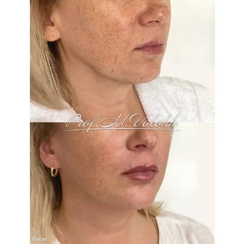 пациентка 45 лет. консультация врача. пластика века уставший взгляд. над верхним веком нависла кожа. врач сидит на кровати.